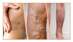 VeinTarget Microneedle Patch