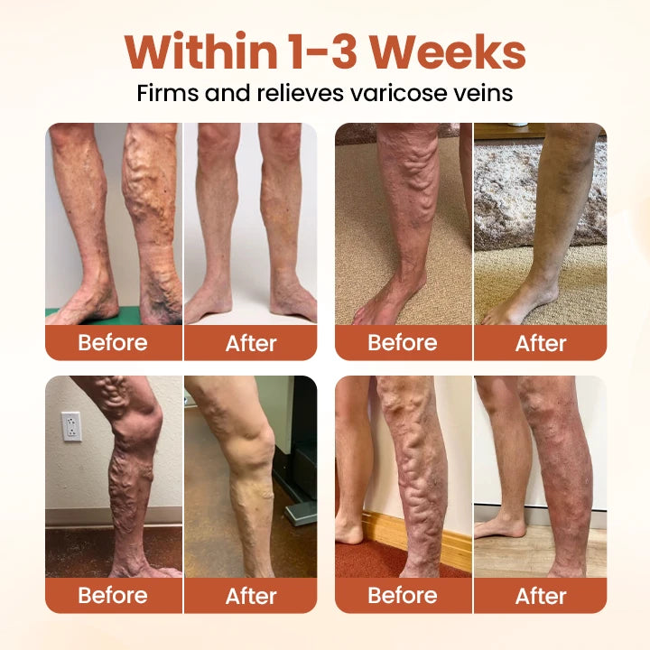 VeinTarget Microneedle Patch
