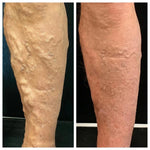 Vein Therapy Cream