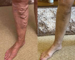 Vein Therapy Cream