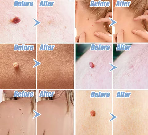 Auto Micro Skin Tag Remover