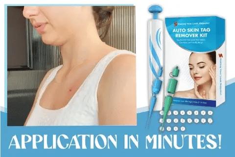 Auto Micro Skin Tag Remover