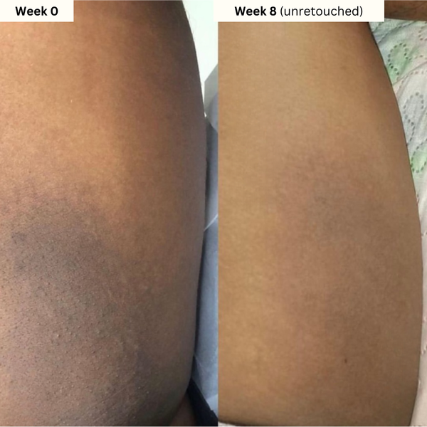 Turmeric & Kojic Acid Soap