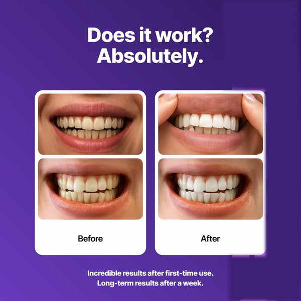PearlSmile Whitening Strips