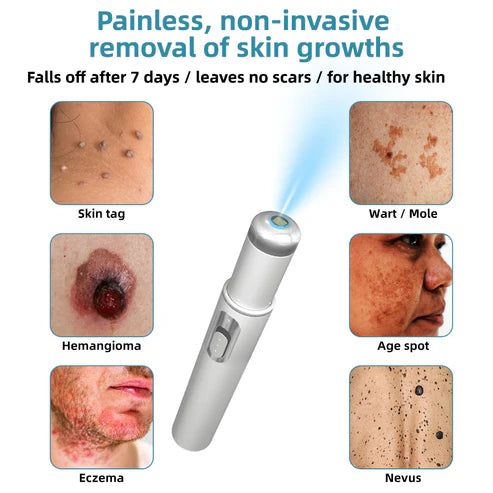 Non-Invasive Mole and Wart Removal Laser Pen
