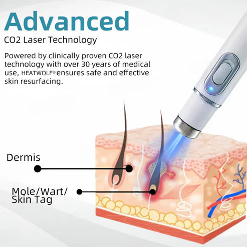 Non-Invasive Mole and Wart Removal Laser Pen