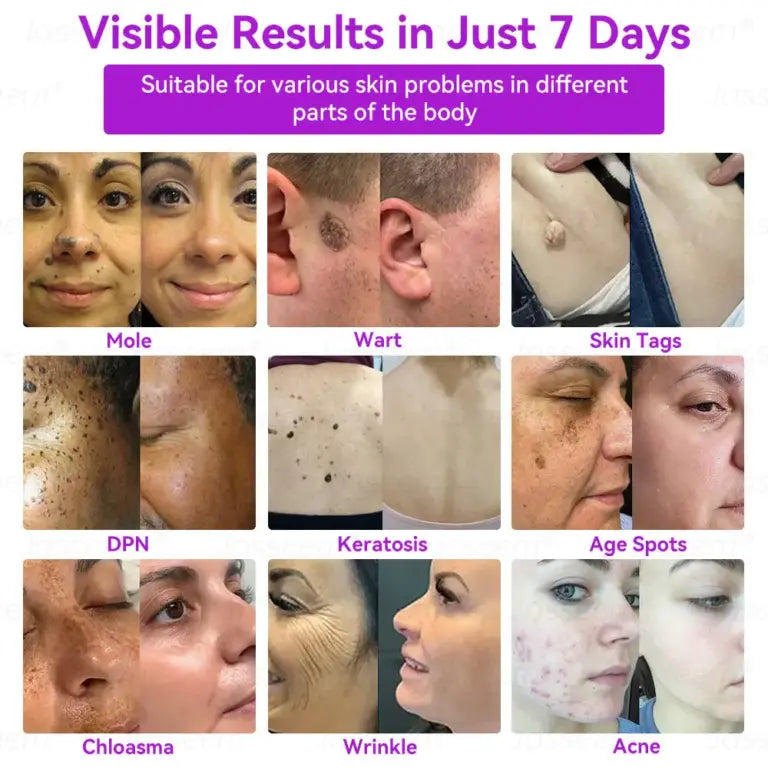 Advanced Non-Invasive Skin Repair CO₂ Laser Pen